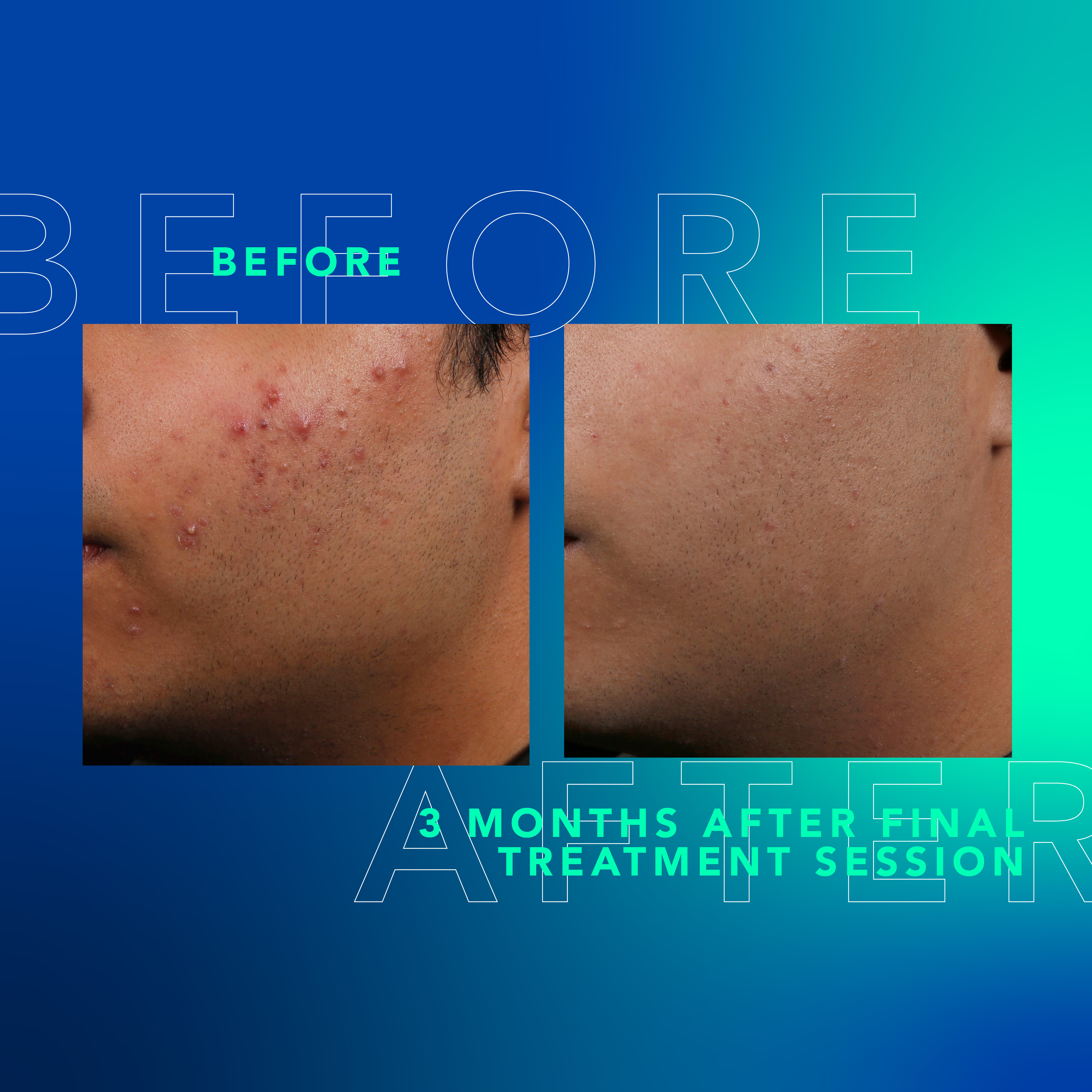 aviclear 3 month before and after